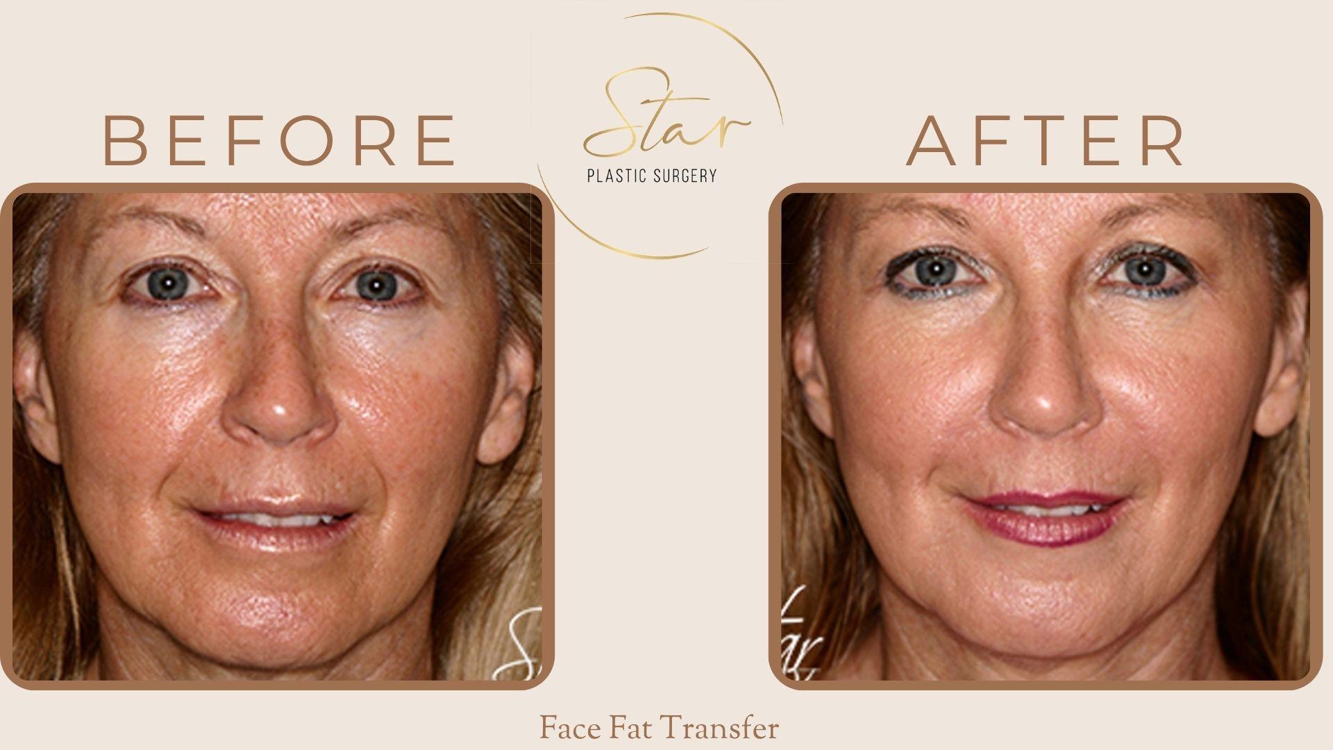 Star Plastic Surgery fat transfer result — Novi, MI
