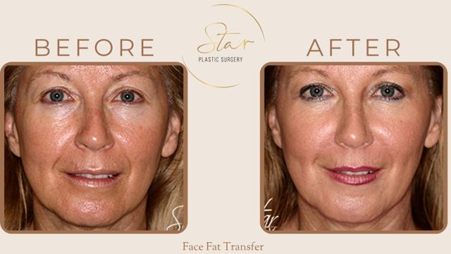 Fat Transfer result at Star Plastic Surgery in Novi, MI