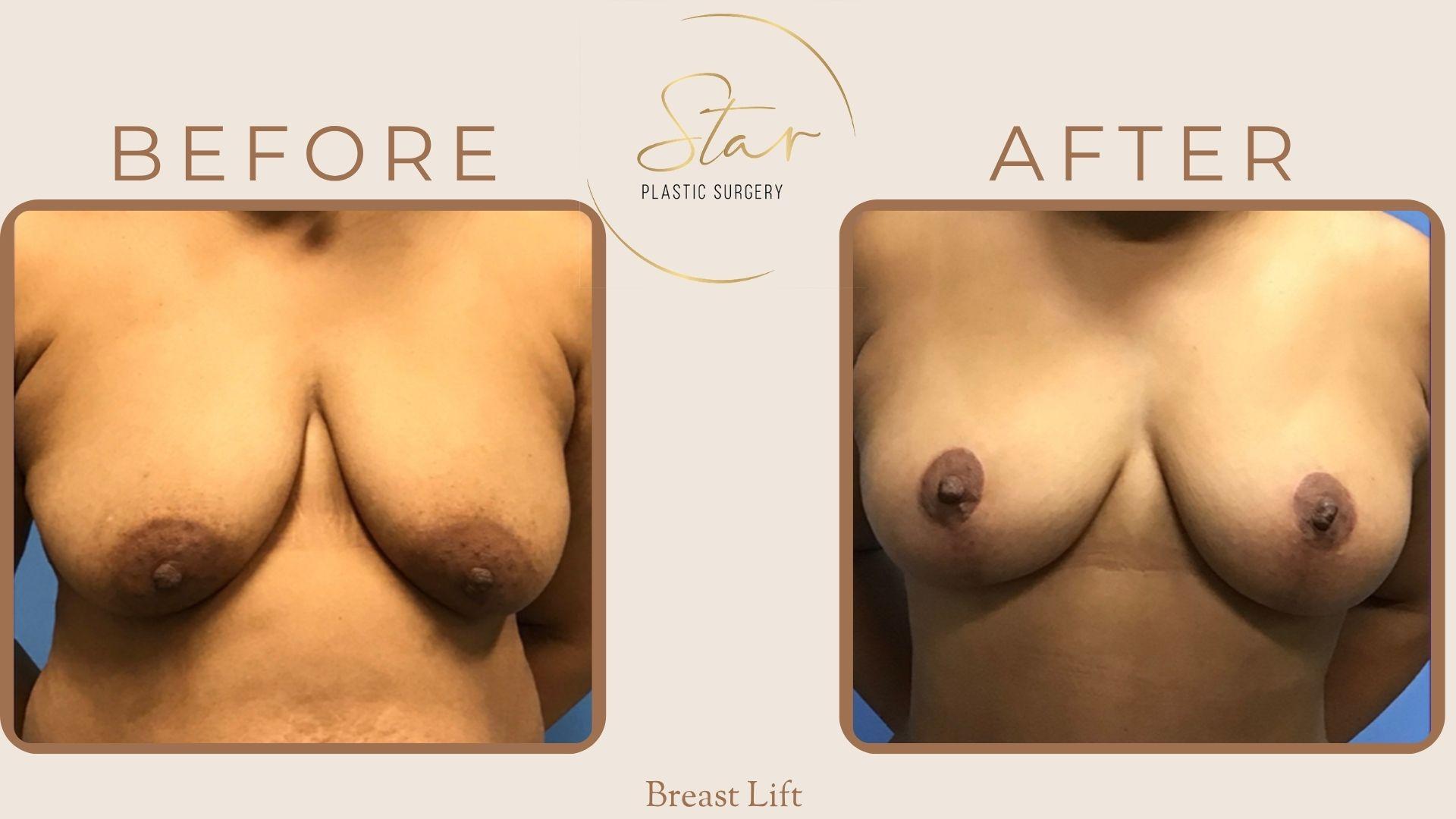 Star Plastic Surgery breast lift result — Novi, MI