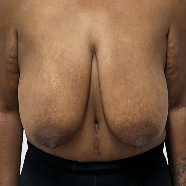 Breast Reduction before at Tri Valley Plastic Surgery in Dublin, CA