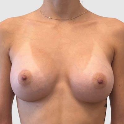 Tri Valley Plastic Surgery breast augmentation after — Dublin, CA