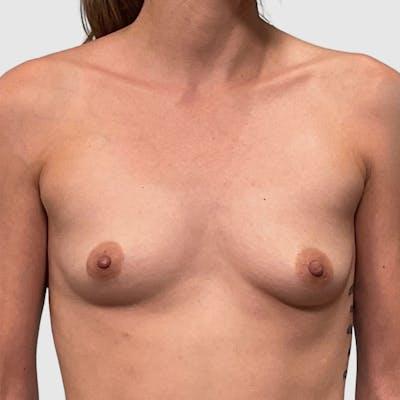 Breast Augmentation before at Tri Valley Plastic Surgery in Dublin, CA