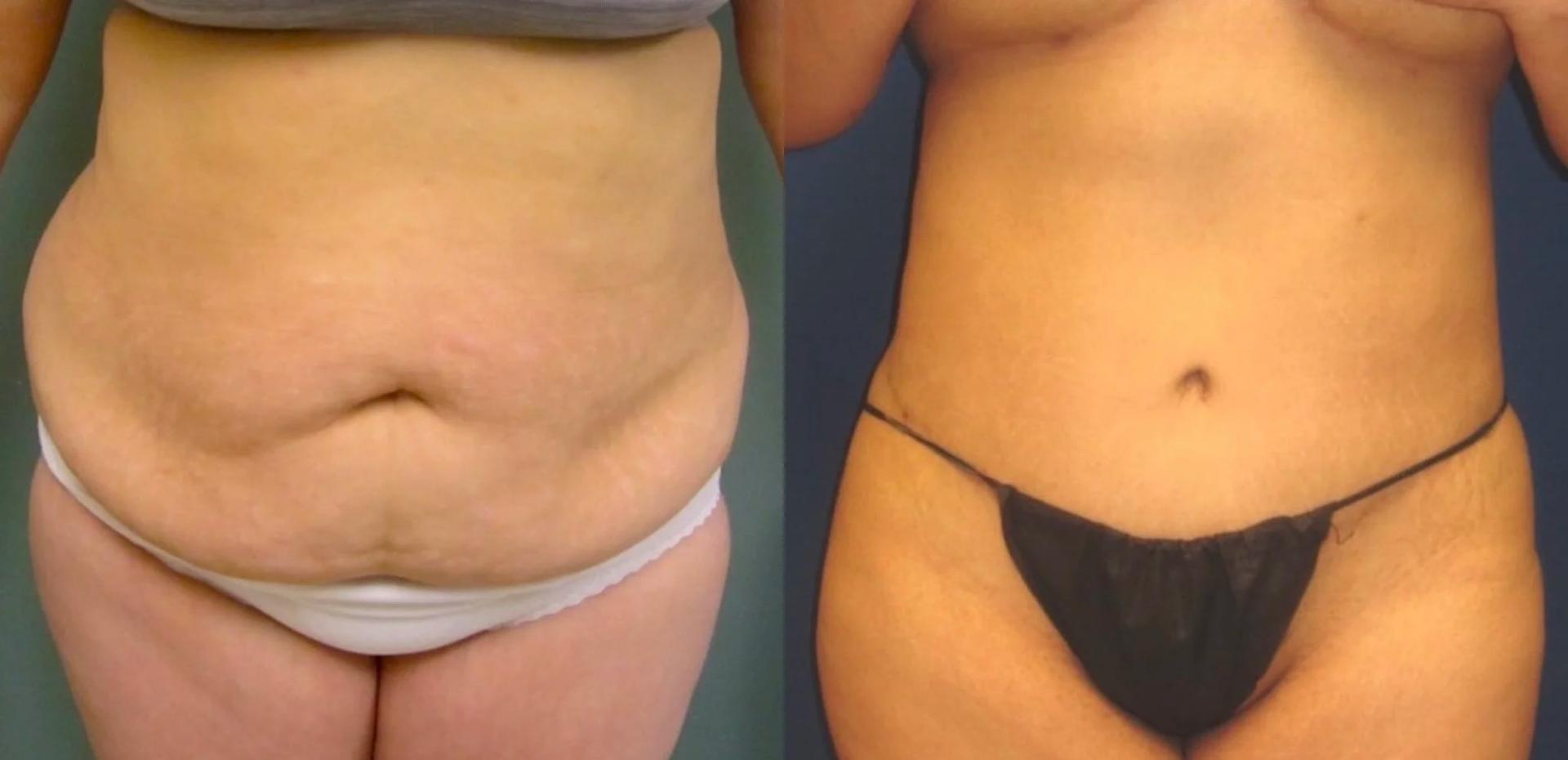 Black Swan Plastic Surgery tummy tuck result — Orlando, FL