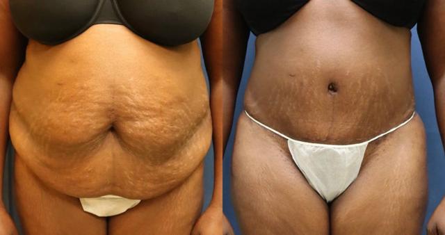 Mini Tummy Tuck result at Black Swan Plastic Surgery in Orlando, FL