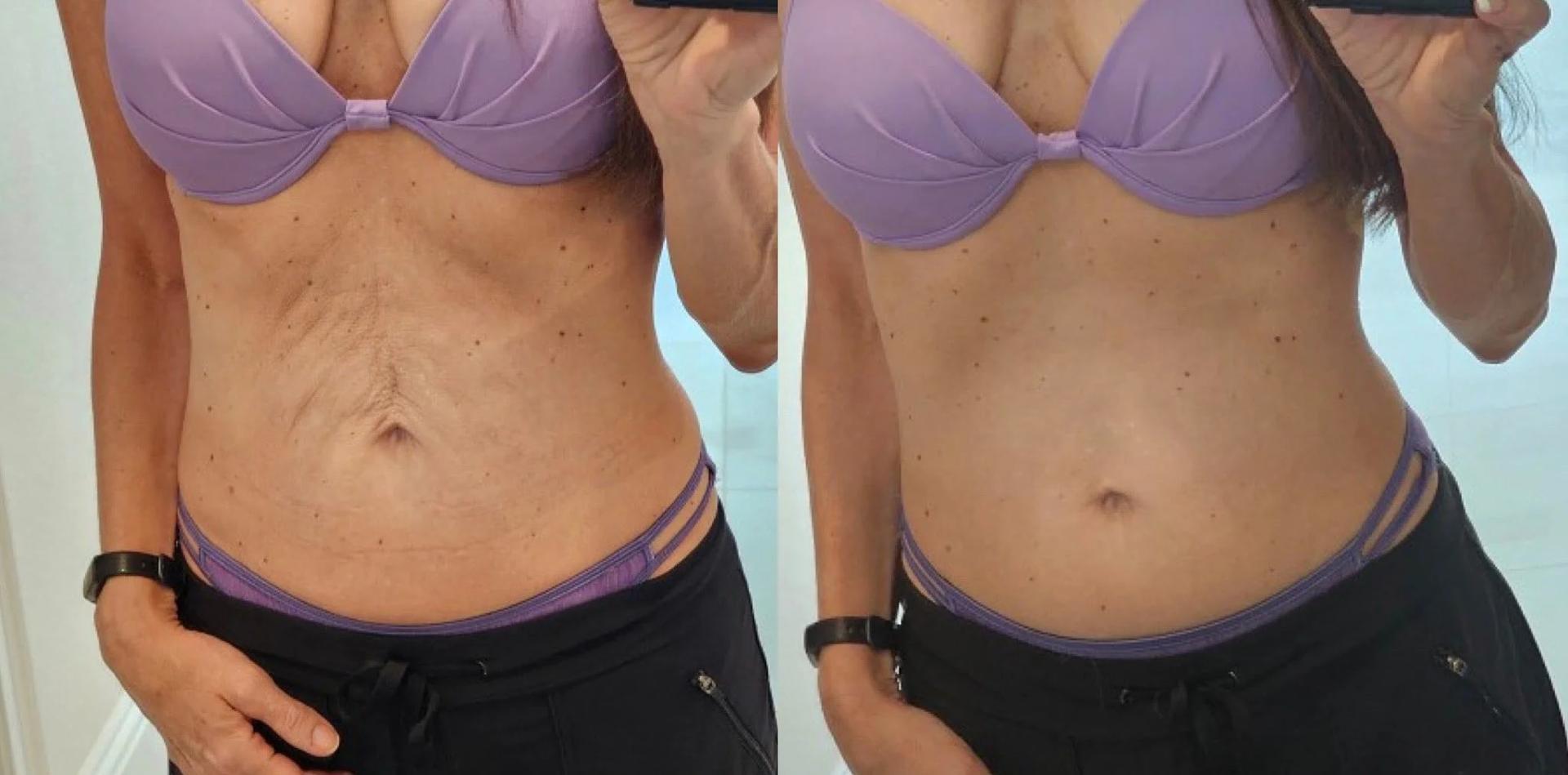 Black Swan Plastic Surgery tummy tuck result — Orlando, FL