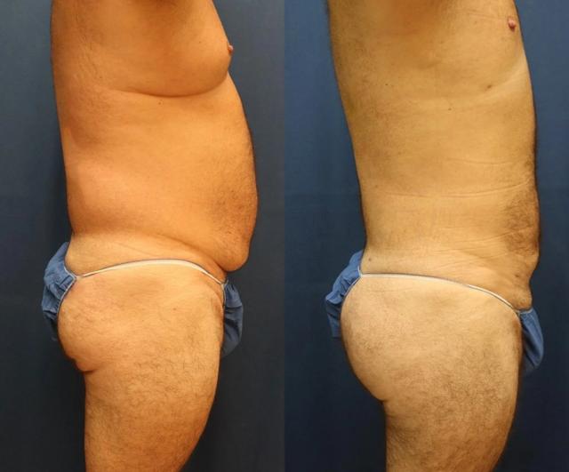 Liposuction result at Black Swan Plastic Surgery in Orlando, FL
