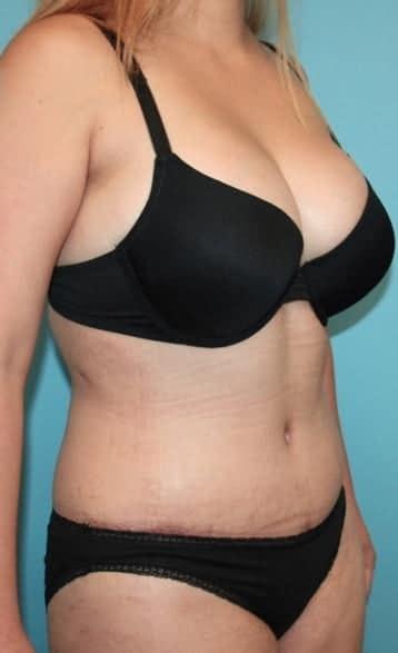 Dr. Cat Plastic Surgery tummy tuck after — Beverly Hills, CA