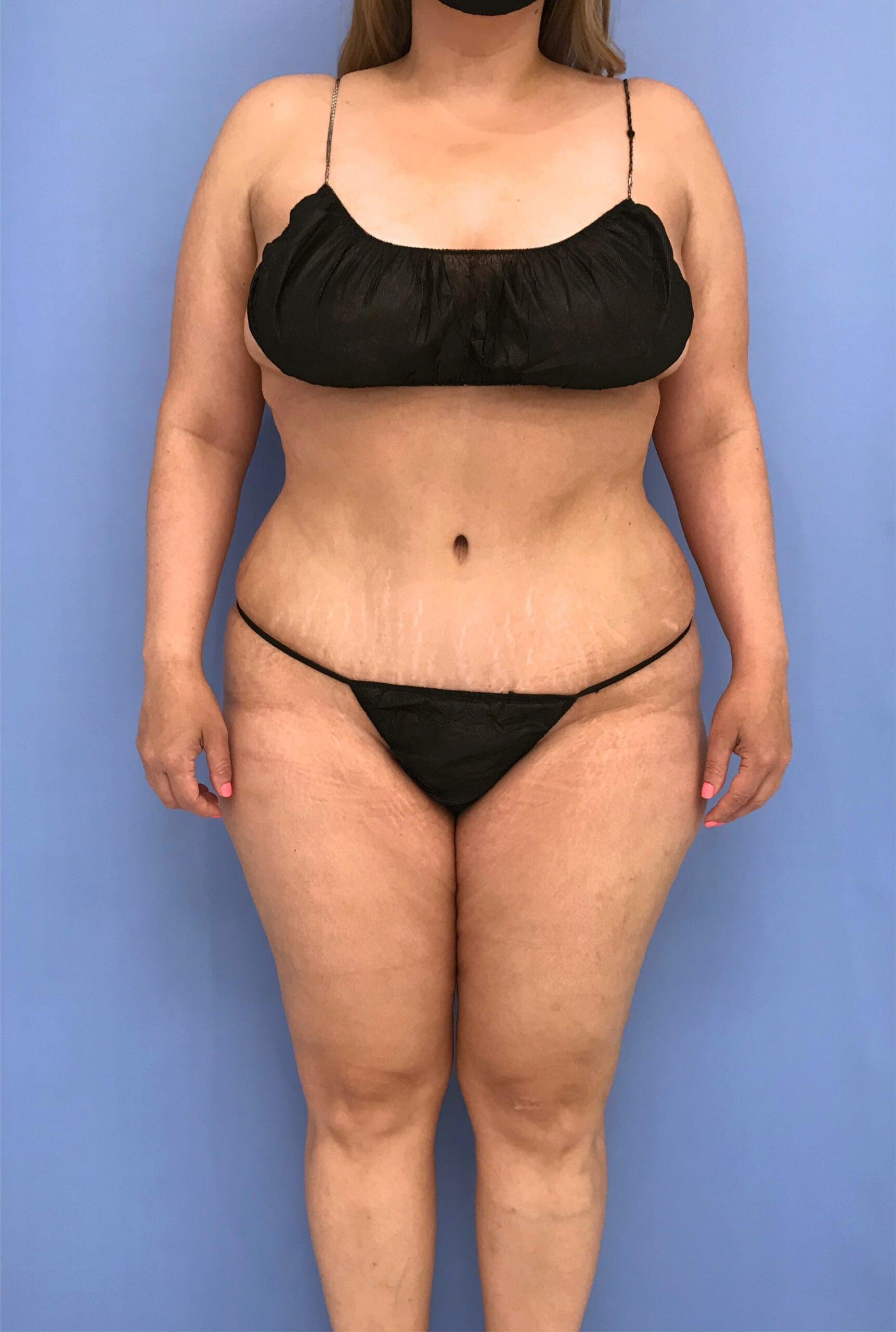Dr. Cat Plastic Surgery tummy tuck after — Beverly Hills, CA