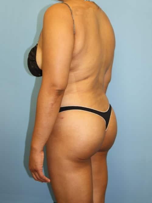 Dr. Cat Plastic Surgery bbl after — Beverly Hills, CA