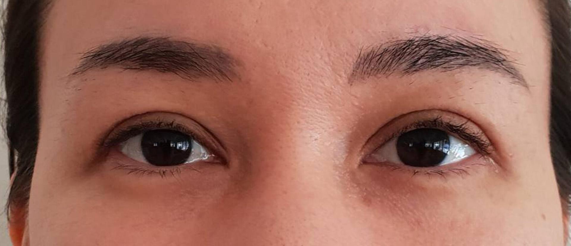 Dr. Cat Plastic Surgery eyelid lift after — Beverly Hills, CA