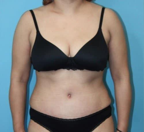 Dr. Cat Plastic Surgery tummy tuck after — Beverly Hills, CA