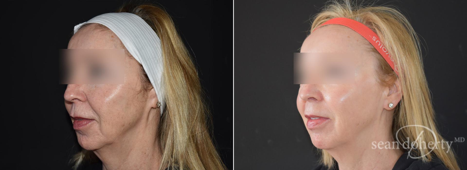 Dr. Sean Doherty - Plastic Surgery laser treatment result — Boston, MA