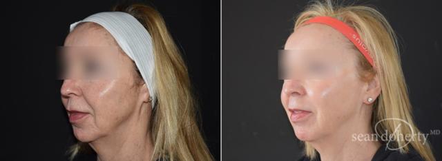 Morpheus8 result at Dr. Sean Doherty - Plastic Surgery in Boston, MA