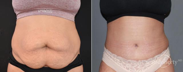 Tummy Tuck result at Dr. Sean Doherty - Plastic Surgery in Boston, MA