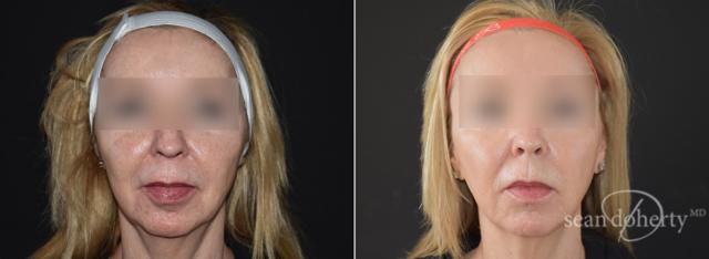 Morpheus8 result at Dr. Sean Doherty - Plastic Surgery in Boston, MA