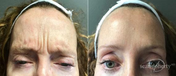 Botox result at Dr. Sean Doherty - Plastic Surgery in Boston, MA