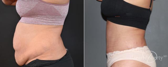 Tummy Tuck result at Dr. Sean Doherty - Plastic Surgery in Boston, MA