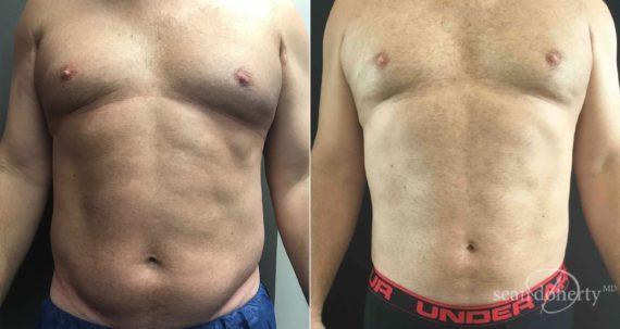 Liposuction result at Dr. Sean Doherty - Plastic Surgery in Boston, MA