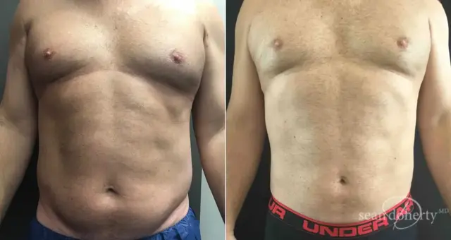Liposuction result at Dr. Sean Doherty - Plastic Surgery in Boston, MA