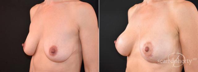 Breast Augmentation result at Dr. Sean Doherty - Plastic Surgery in Boston, MA