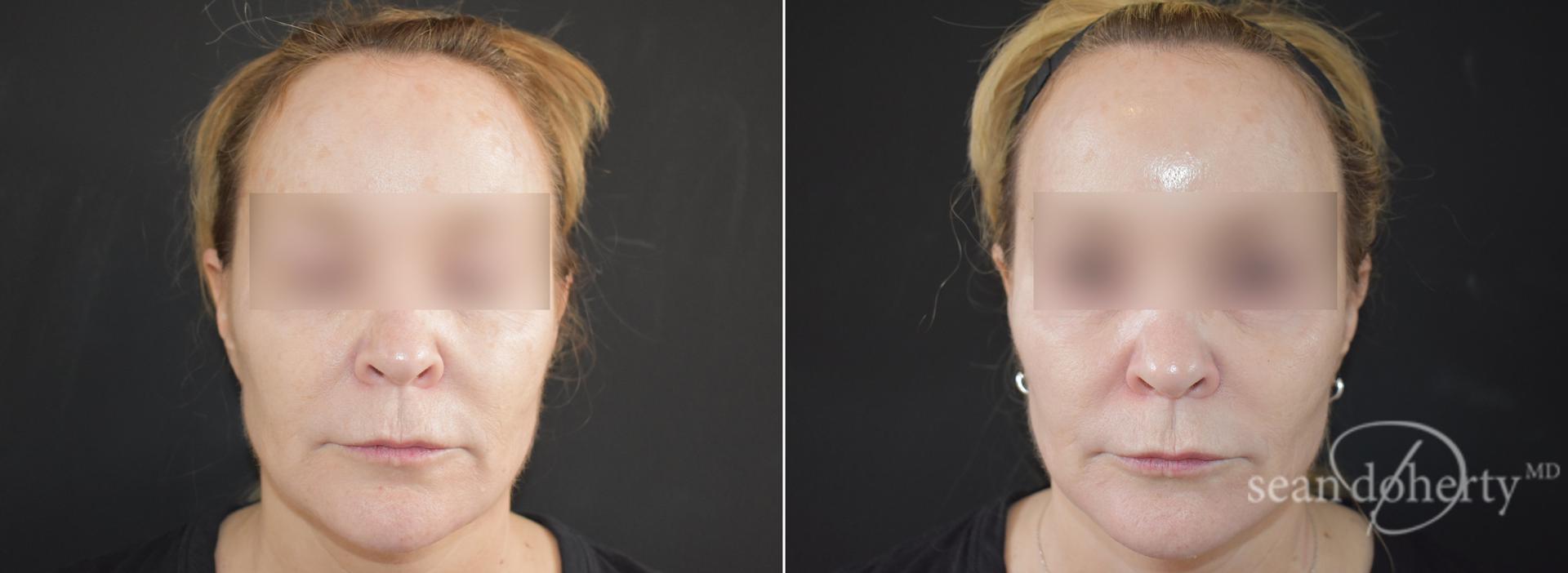 Dr. Sean Doherty - Plastic Surgery laser treatment result — Boston, MA