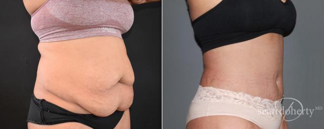Tummy Tuck result at Dr. Sean Doherty - Plastic Surgery in Boston, MA