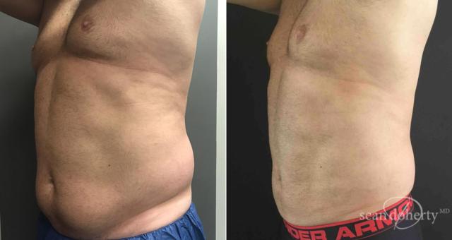 Liposuction result at Dr. Sean Doherty - Plastic Surgery in Boston, MA
