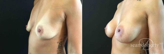 Breast Augmentation result at Dr. Sean Doherty - Plastic Surgery in Boston, MA