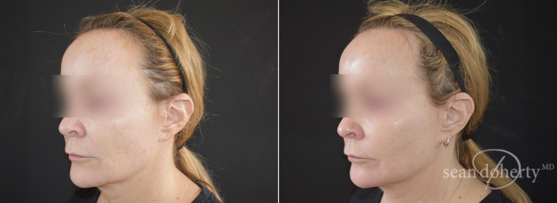 Dr. Sean Doherty - Plastic Surgery laser treatment result — Boston, MA