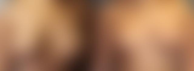 Breast Lift result at Dr. Sean Doherty - Plastic Surgery in Boston, MA