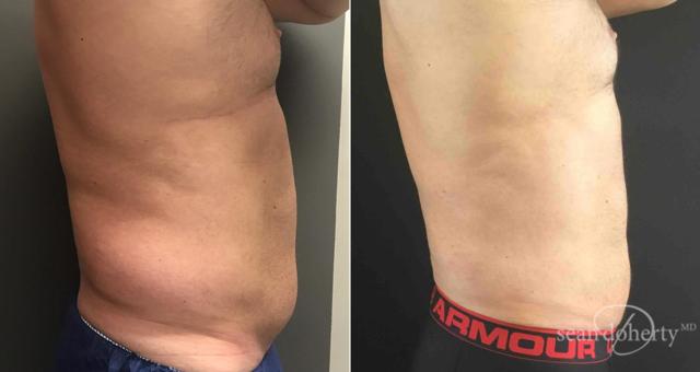 Liposuction result at Dr. Sean Doherty - Plastic Surgery in Boston, MA