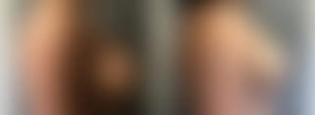 Breast Lift result at Dr. Sean Doherty - Plastic Surgery in Boston, MA