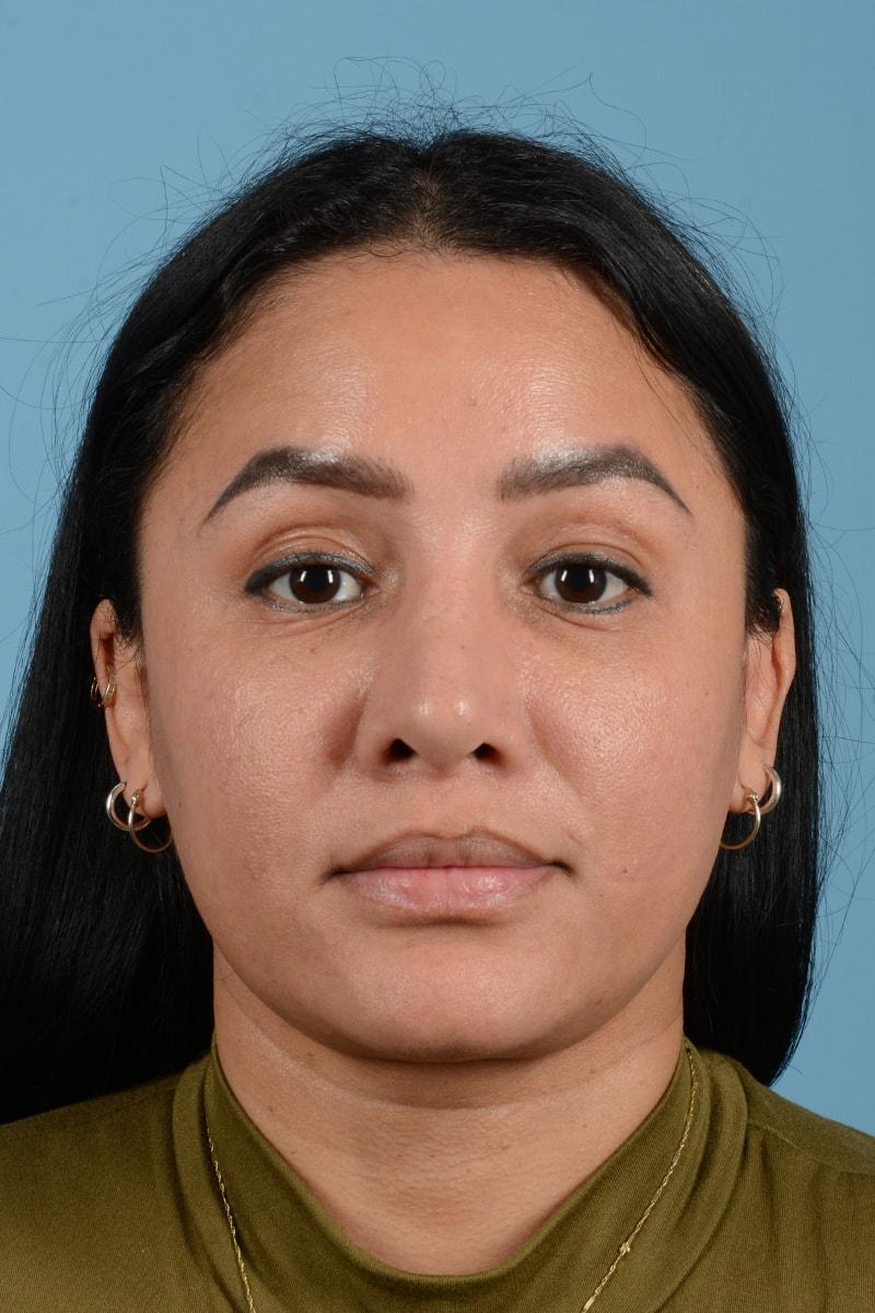 Henry A. Mentz, MD eyelid lift after — Houston, TX
