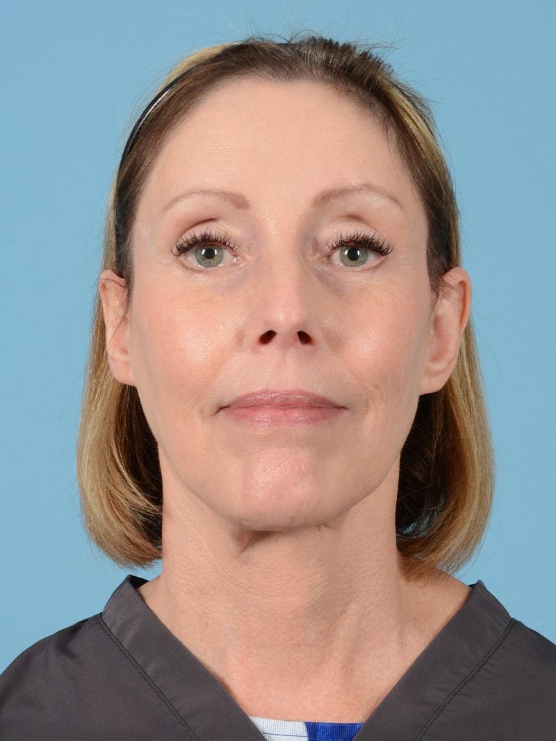 Henry A. Mentz, MD eyelid lift after — Houston, TX