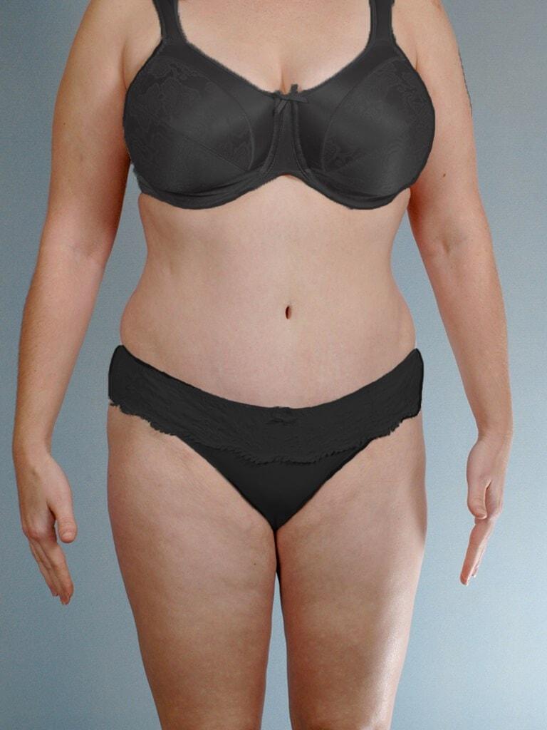 Henry A. Mentz, MD tummy tuck after — Houston, TX