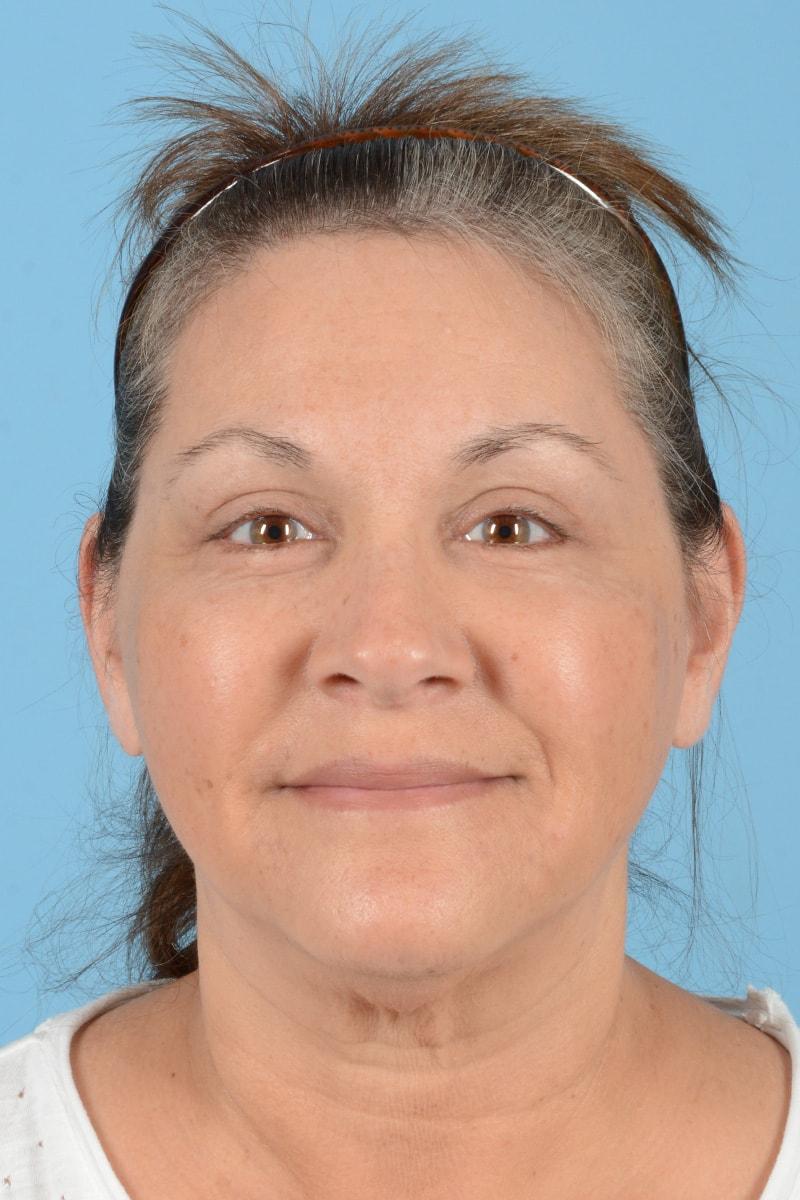 Henry A. Mentz, MD eyelid lift after — Houston, TX