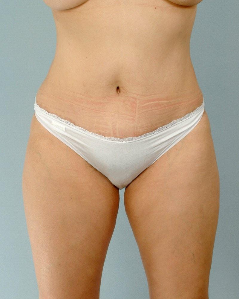 Henry A. Mentz, MD tummy tuck after — Houston, TX