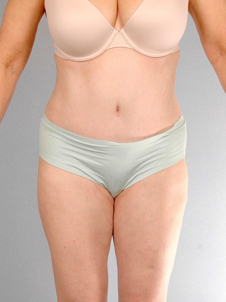 Henry A. Mentz, MD tummy tuck after — Houston, TX