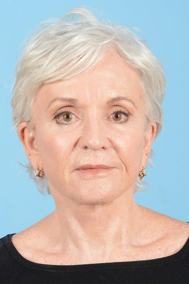 Henry A. Mentz, MD eyelid lift after — Houston, TX