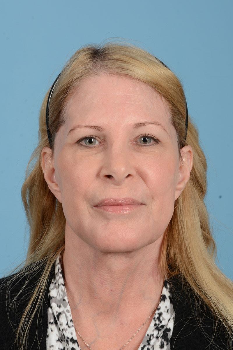 Henry A. Mentz, MD eyelid lift after — Houston, TX