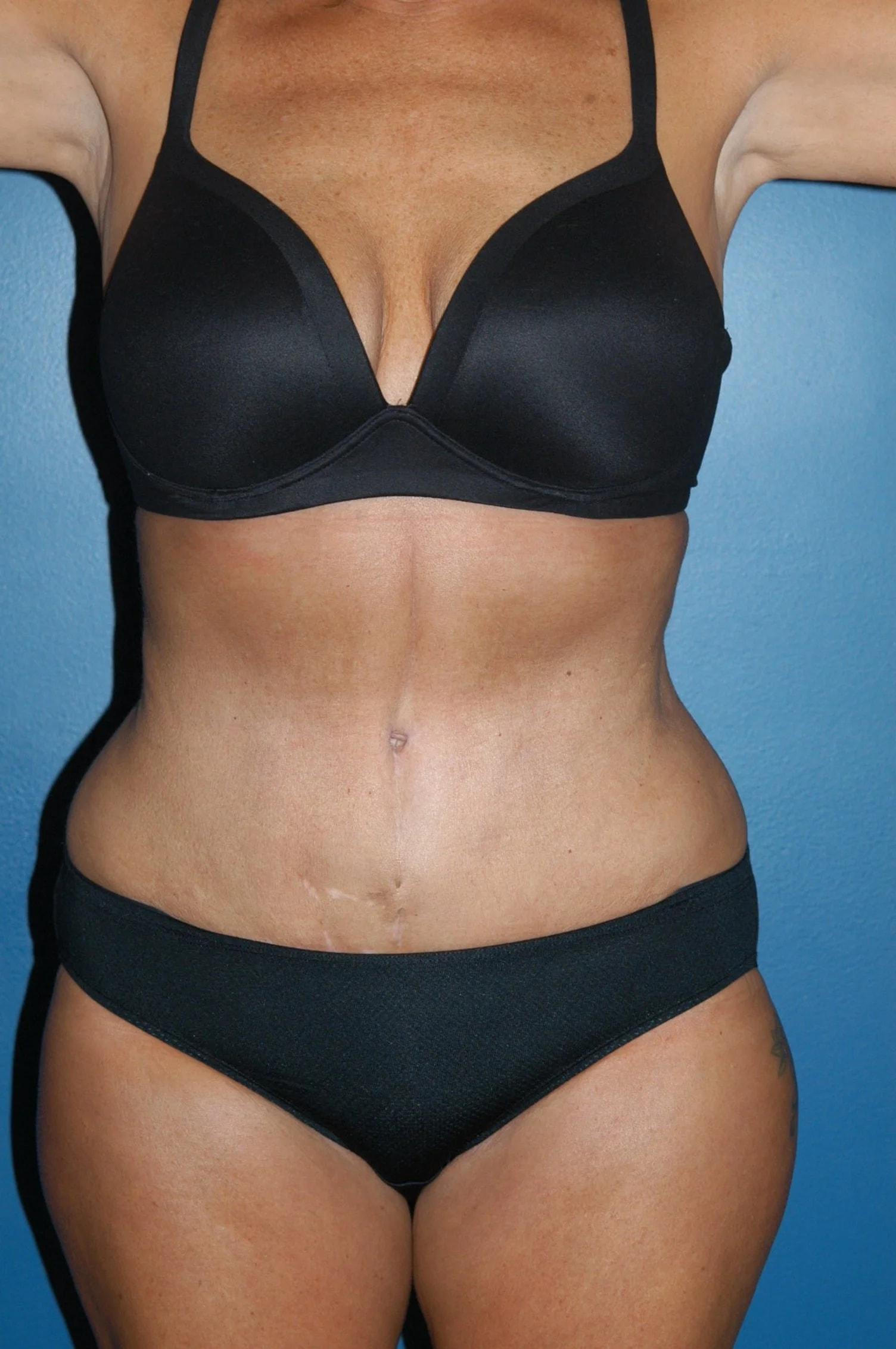North Shore Plastic Surgery & Med Spa tummy tuck after — Peabody, MA