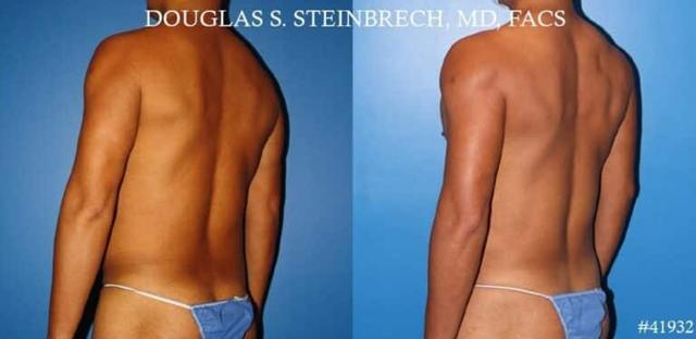 Fat Transfer result at Gotham Plastic Surgery in New York, NY