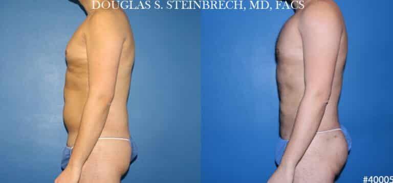 Gotham Plastic Surgery liposuction result — New York, NY