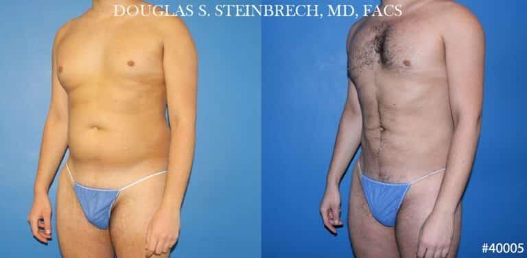 Gotham Plastic Surgery liposuction result — New York, NY