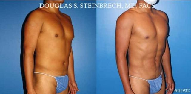 Fat Transfer result at Gotham Plastic Surgery in New York, NY