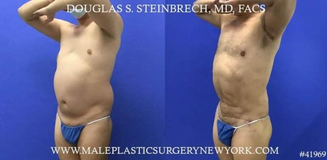 Tummy Tuck result at Gotham Plastic Surgery in New York, NY