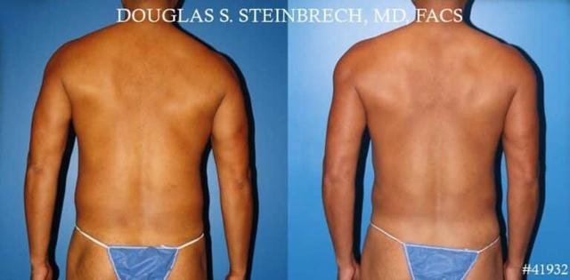 Fat Transfer result at Gotham Plastic Surgery in New York, NY