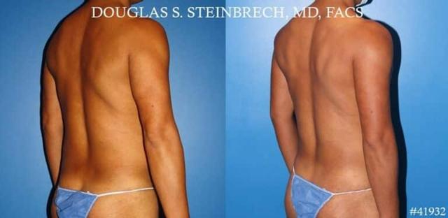 Fat Transfer result at Gotham Plastic Surgery in New York, NY