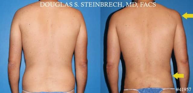 Liposuction result at Gotham Plastic Surgery in New York, NY