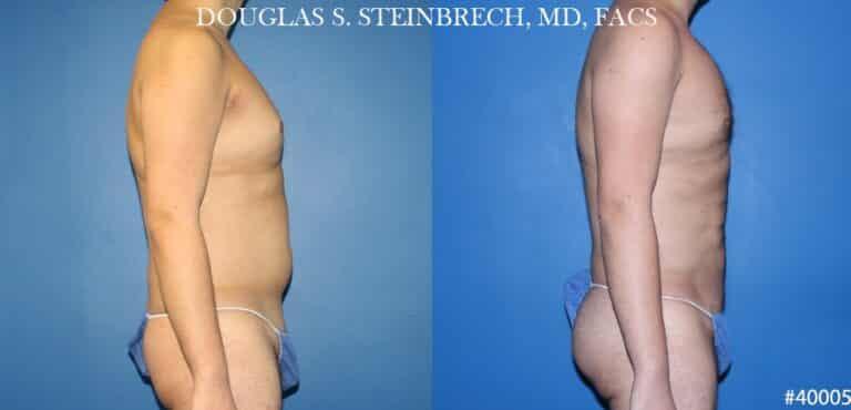 Gotham Plastic Surgery liposuction result — New York, NY